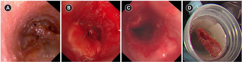 Young woman with recurrent paroxysmal stridor after extubation.