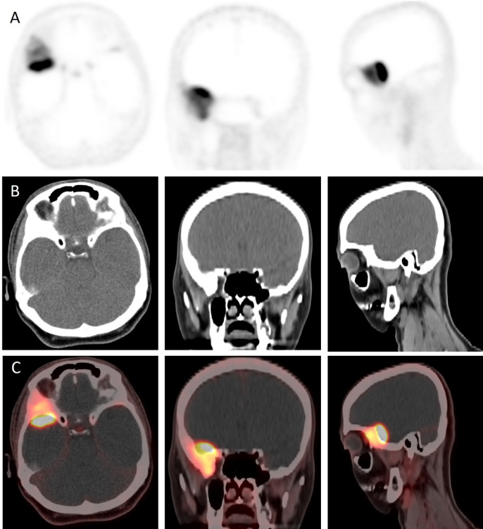 Molecular Perspectives on Meningioma with Osseous Infiltration Revealed by <sup>68</sup>Ga-DOTA TOC PET-CT.