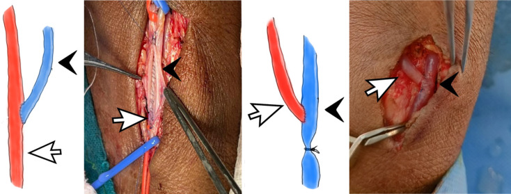 Radial artery deviation and reimplantation technique <i>vs</i> classical technique in arterio-venous fistula: A randomised control trial.