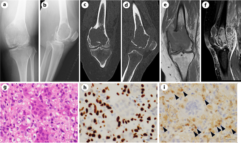 Beta-Catenin Positive Giant Cell Tumor of Bone with Pathological Fracture Treated with Neoadjuvant Denosumab Therapy for Visualizing Extraskeletal Lesions.
