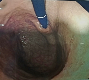 Behçet's Disease and Autoimmune Atrophic Gastritis: An Incidental Finding.