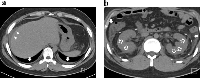 Prognostic value of a new computed tomography severity score in hemorrhagic fever with renal syndrome.