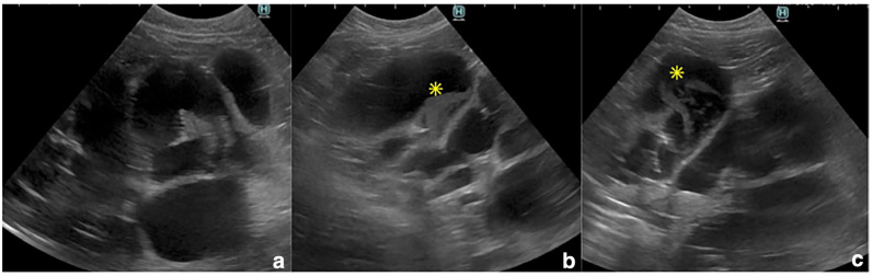 Choledochoduodenostomy in a cat with extrahepatic biliary obstruction: simple side-to-side anastomosis technique.