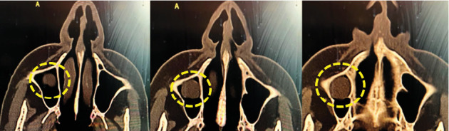 Symptomatic Maxillary Sinus Retention Cyst Following a Prior Sinus Perforation: A Case Report.