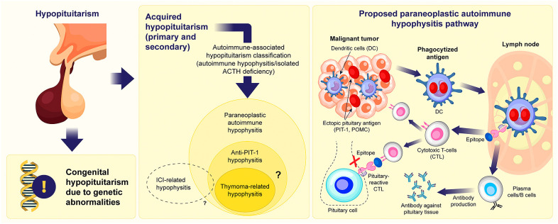 Hypopituitarism: genetic, developmental, and acquired etiologies with a focus on the emerging concept of autoimmune hypophysitis.