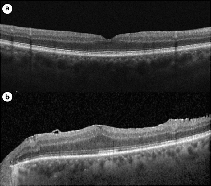 A Case of Epiretinal Membrane Masquerading as Foveal Hypoplasia Uncovered by Optical Coherence Tomography Angiography.