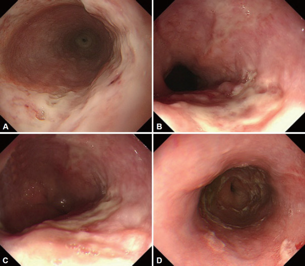 Infective Esophagitis.