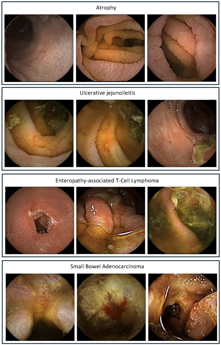 Navigating celiac disease with small bowel capsule endoscopy: current state and future horizons.