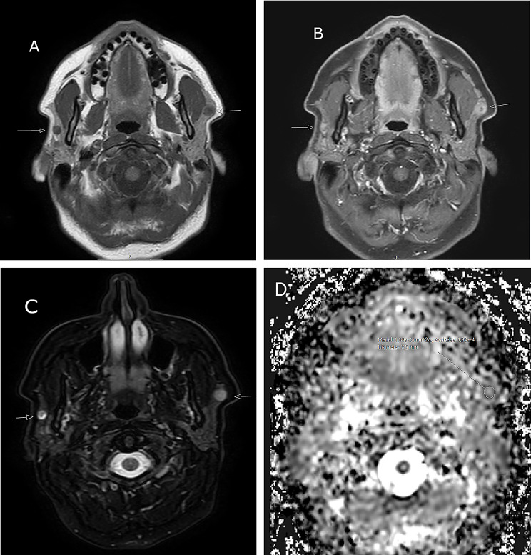 Bilateral synchronous salivary gland tumors: report of three cases.