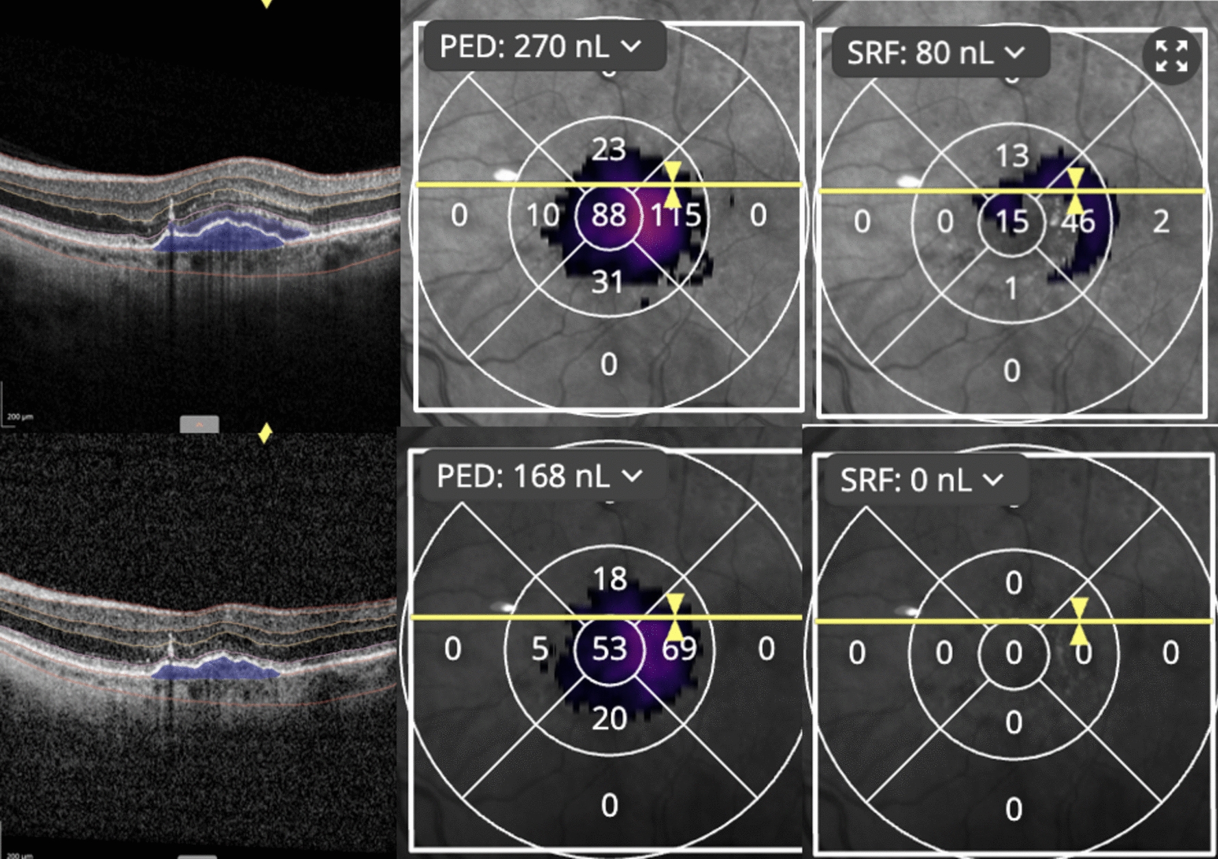 Faricimab for treatment-resistant choroidal neovascularization (CNV) in neovascular age-related macular degeneration (nAMD): seven-months results using artificial intelligence and OCTA.