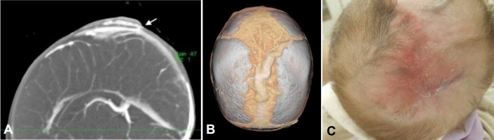 Aplasia cutis congenita with unique vascular malformation and cranial hypoplasia: a case in a preterm infant.