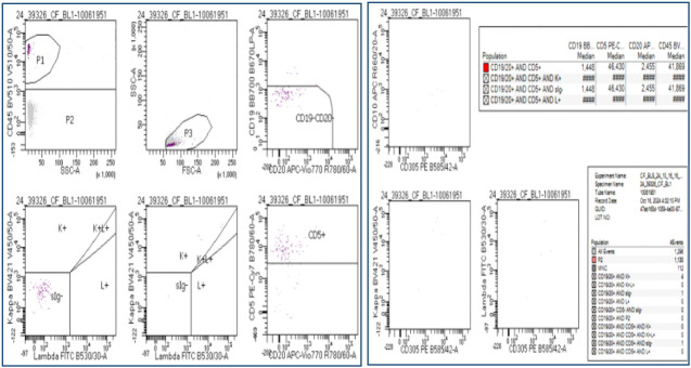 Diagnosis of a secondary central nervous system Lymphoma (SCNSL) in a patient with low proliferative Mantle cell lymphoma.