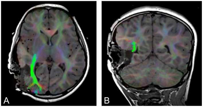 The use of intraoperative tractography in brain tumor and epilepsy surgery: a systematic review and meta-analysis.