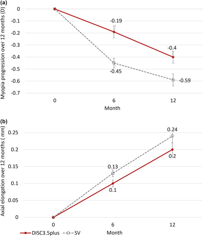 Myopia control using a modified optical defocus soft contact lens in schoolchildren-A 12-month randomised double masked control trial.