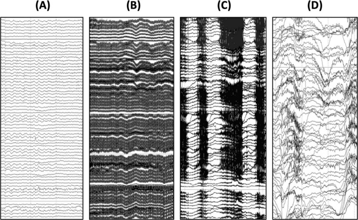 Considerations and procedures for acquiring EEG as part of multi-site studies for Rett syndrome and other genetic neurodevelopmental disorders.