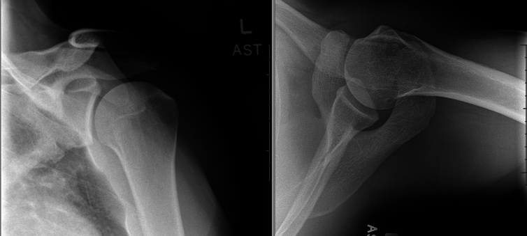 <i>Latissimus Dorsi</i> Tendon Repair Through Single-Incision Axillary Approach Using All-Suture Anchor Tension Slide.