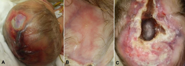 Aplasia cutis congenita with unique vascular malformation and cranial hypoplasia: a case in a preterm infant.