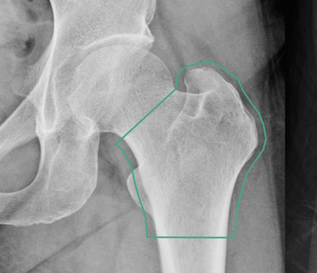 Opportunistic assessment of osteoporosis using hip and pelvic X-rays with OsteoSight™: validation of an AI-based tool in a US population.