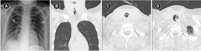 Young woman with recurrent paroxysmal stridor after extubation.
