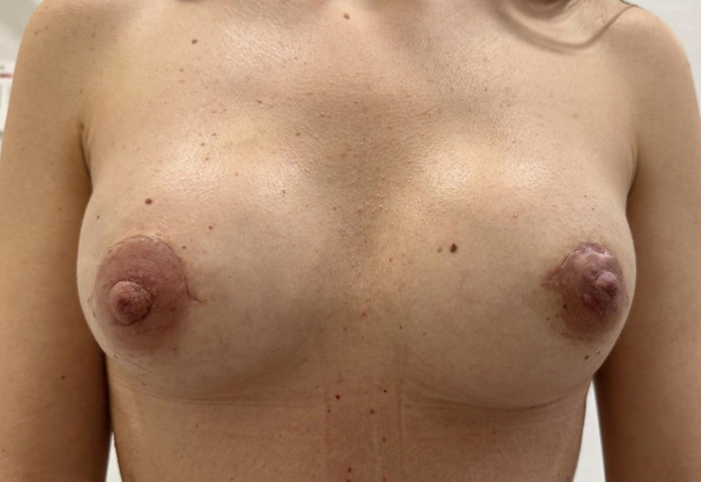 Advocating for optimal surgical approaches in prepectoral implant breast reconstruction.