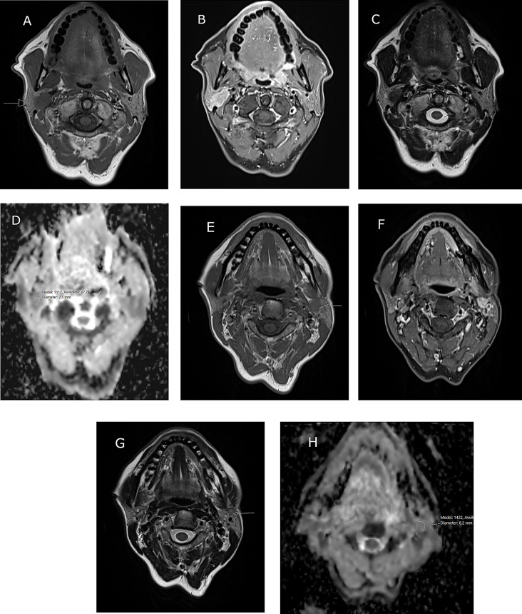 Bilateral synchronous salivary gland tumors: report of three cases.