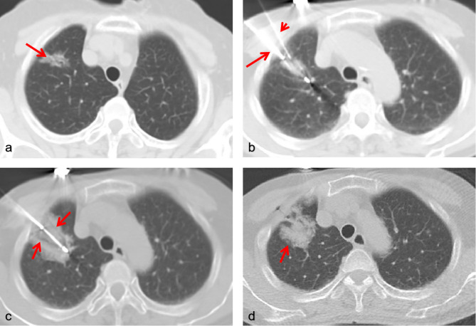 Efficacy and safety in synchronous core-needle biopsy and cryoablation for highly suspicious malignant pulmonary nodule.