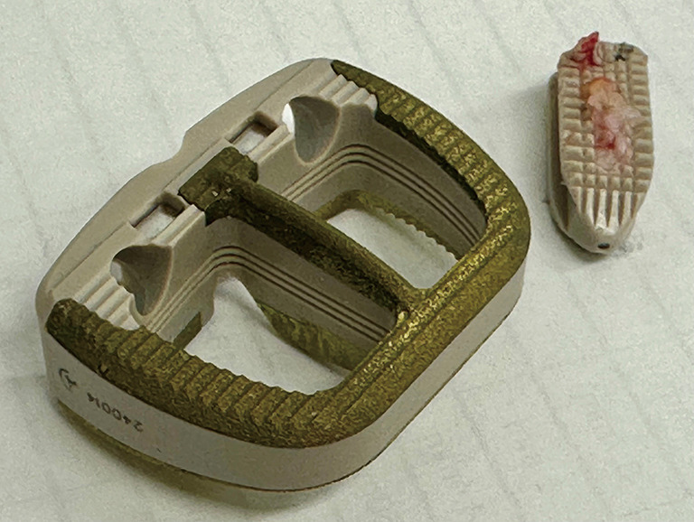 The evolving role of lateral lumbar interbody fusion in lumbar fusion: challenging the dominance of transforaminal interbody fusion.
