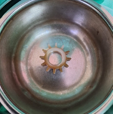 A forgotten pleasure: A unique case report of a neglected foreign body in a postmenopausal woman with persistent vaginal discharge.