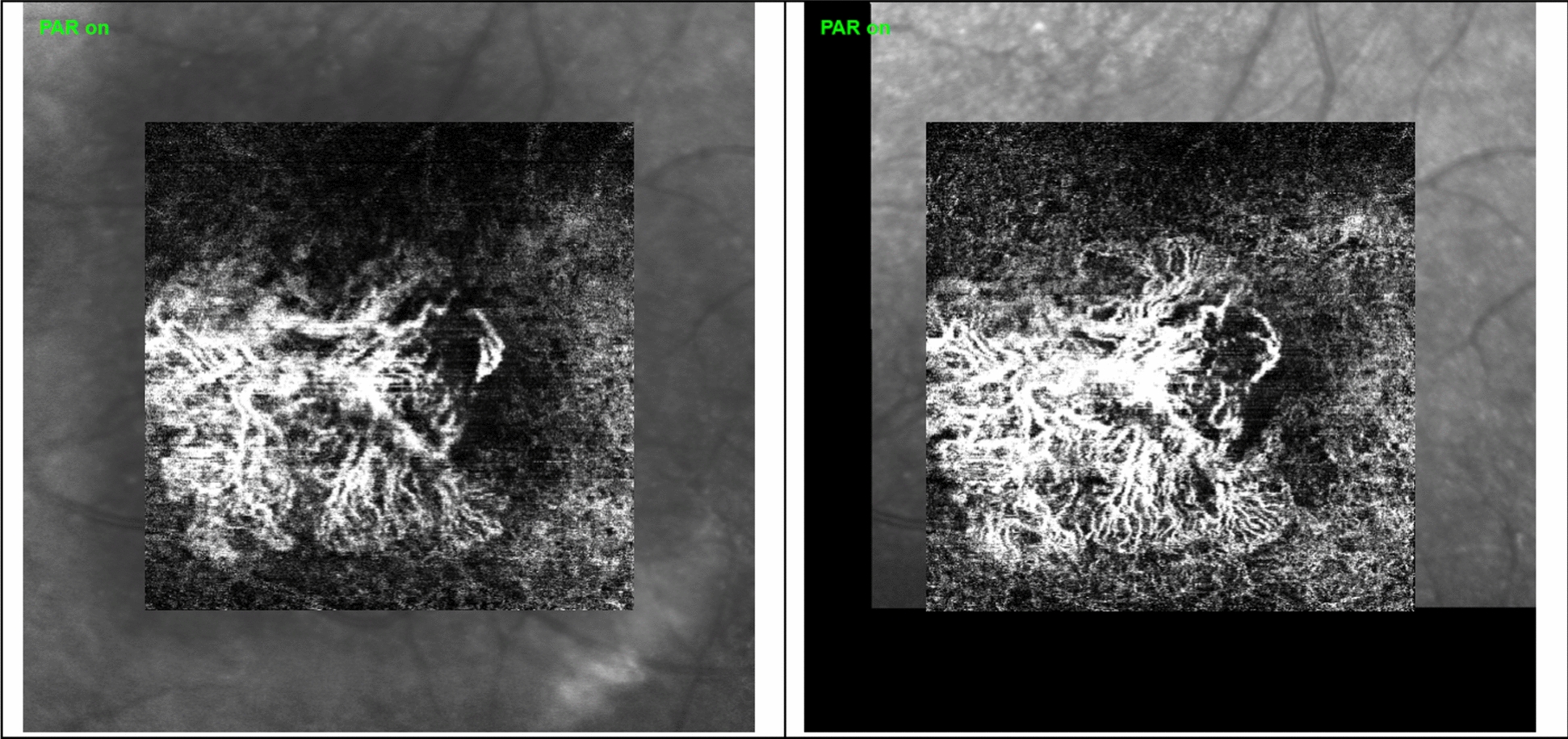 Faricimab for treatment-resistant choroidal neovascularization (CNV) in neovascular age-related macular degeneration (nAMD): seven-months results using artificial intelligence and OCTA.