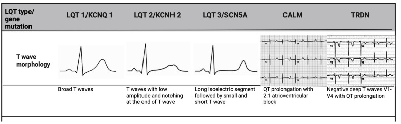 Congenital Long QT Syndrome: A Focus on Risk Stratification and Management.