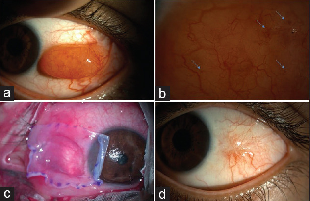 Isolated conjunctival lymphangioma.