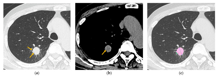 Qualitative and Quantitative Computed Tomography Analyses of Lung Adenocarcinoma for Predicting Spread Through Air Spaces.