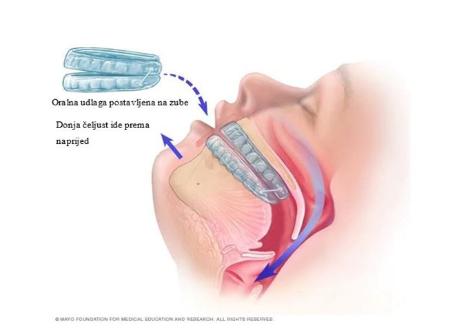 Snoring Symptoms and Obstructive Sleep Apnea Risk Factors Identified by Doctors of Dental Medicine.