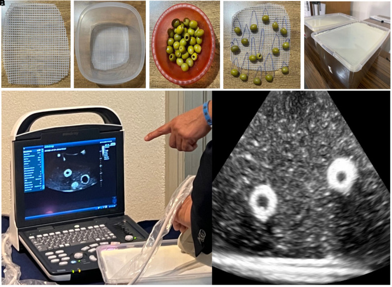 A Low-Cost Gelatin-Based Model for Ultrasound-Guided Percutaneous Renal Access.