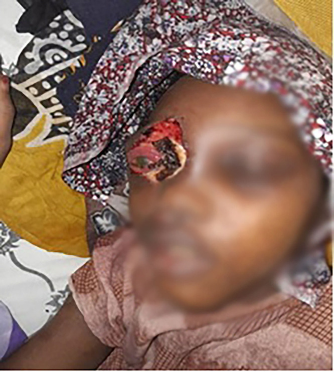 A Rare Battle: Multidisciplinary Care for a Child with Rhino-Orbital Cerebral Mucormycosis in Somali Region of Ethiopia.