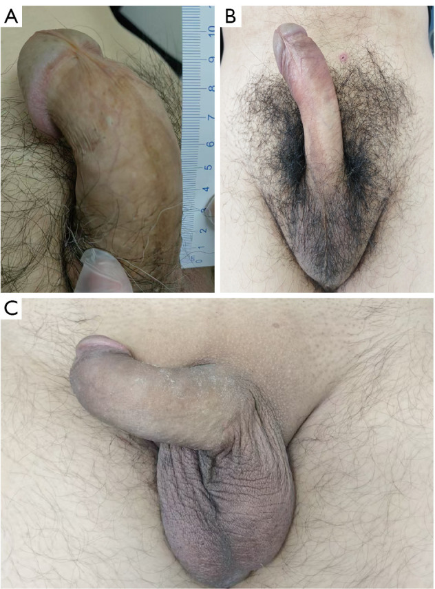 A novel autologous material for the surgical treatment of Peyronie's disease: the outer plate of the prepuce.