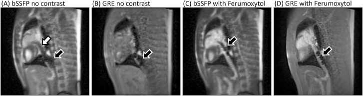 Feasibility of magnetic resonance imaging-guided cardiac catheterization, angioplasty, and stenting in a commercial wide-bore 0.55T scanner.