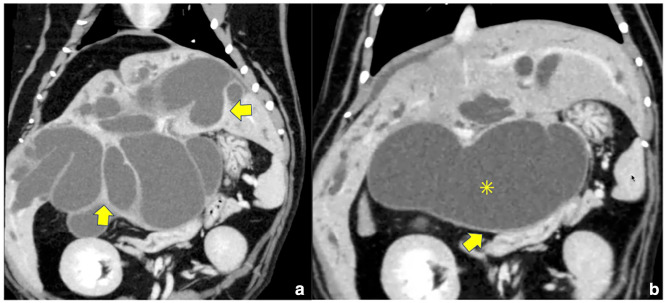 Choledochoduodenostomy in a cat with extrahepatic biliary obstruction: simple side-to-side anastomosis technique.