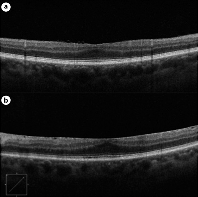 A Case of Epiretinal Membrane Masquerading as Foveal Hypoplasia Uncovered by Optical Coherence Tomography Angiography.