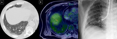 Pulmonary Intravascular Large B-Cell Lymphoma Diagnosed by Transbronchial Lung Cryobiopsy: A Case Report.
