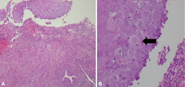 Infective Esophagitis.