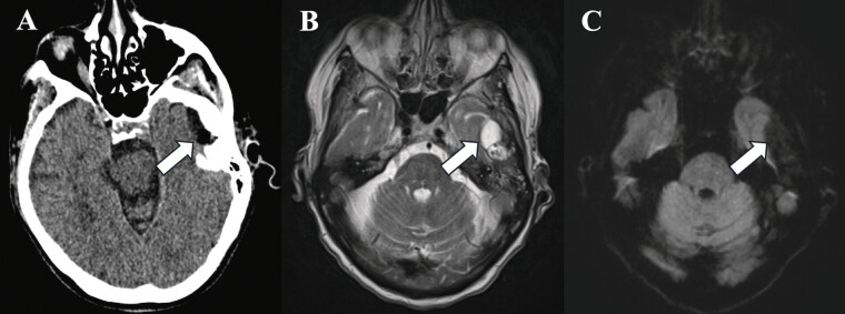 Management of Rare Temporomandibular Joint Cysts with Intracranial Extension: A Case Series and Literature Review.