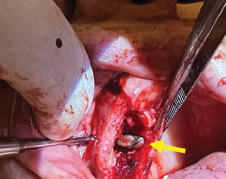 Symptomatic Maxillary Sinus Retention Cyst Following a Prior Sinus Perforation: A Case Report.