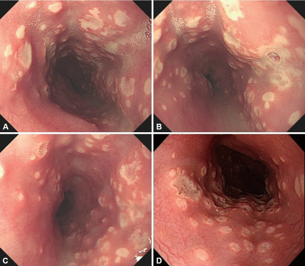 Infective Esophagitis.