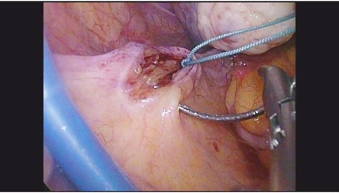 The presacral-uterosacral hysteropexy - a novel native tissue repair for pelvic organ prolapse.