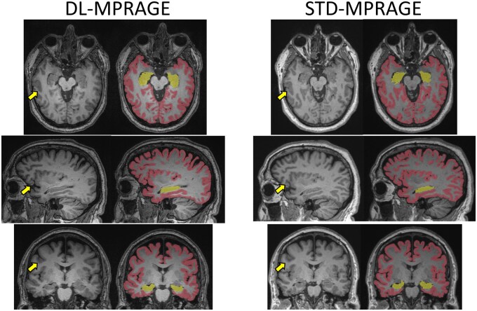 Deep-learning-accelerated T1-MPRAGE MRI for quantification and visual grading of cerebral volume in memory loss patients.