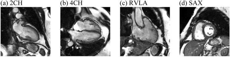 Mean pulmonary artery pressure prediction with explainable multi-view cardiovascular magnetic resonance cine series deep learning model.