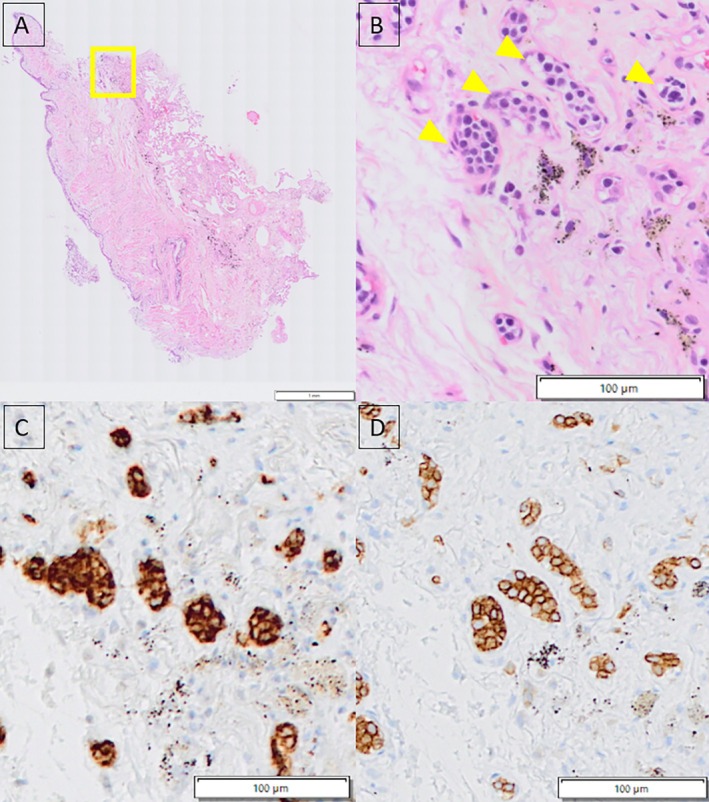 Pulmonary Intravascular Large B-Cell Lymphoma Diagnosed by Transbronchial Lung Cryobiopsy: A Case Report.