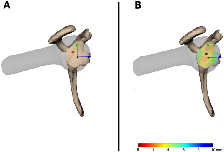 One-year follow-up of 20 patients undergoing the Latarjet procedure : a biomechanical study during an apprehension-relocation test measured with radiostereometry.
