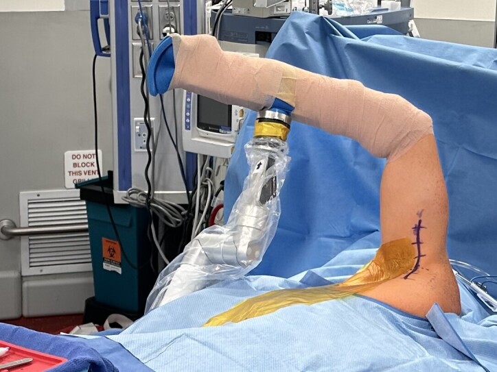 <i>Latissimus Dorsi</i> Tendon Repair Through Single-Incision Axillary Approach Using All-Suture Anchor Tension Slide.